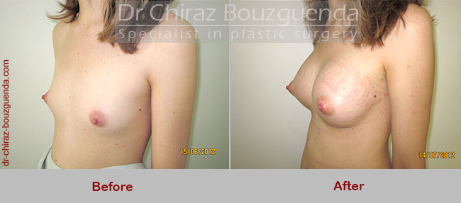 breast augmentation before after photos