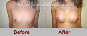 breast augmentation before and after photos