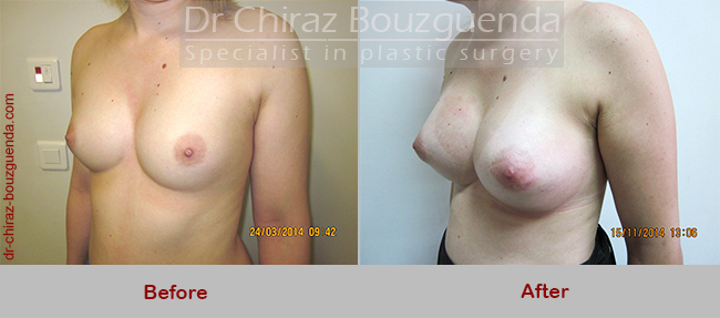 breast implant replacement before after