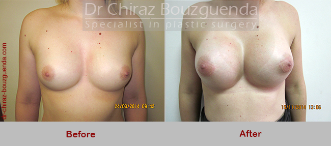 breast implant revision before after photos