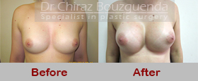 breast implant revision before after