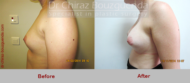 breast implant revision before after pictures