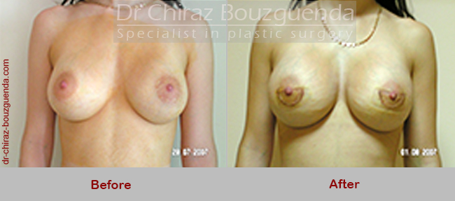 breast implant replacement before after pictures