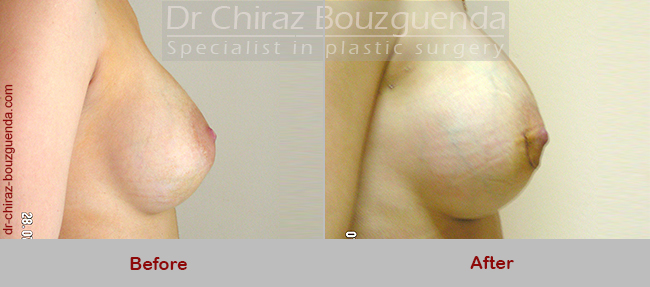 breast implant replacement before after results
