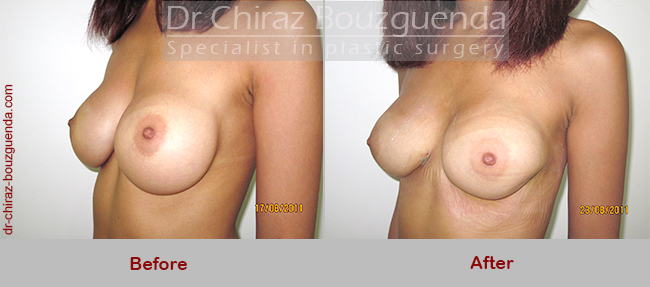 breast implants revision before after results