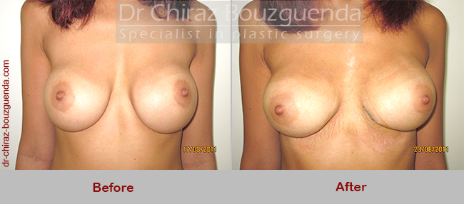 breast implants revision before after photos