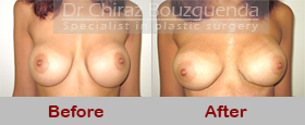 breast implants revision before after