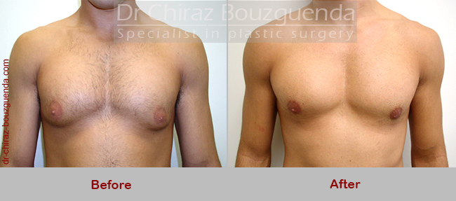 gynecomastia surgery before after photos