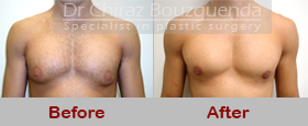 gynecomastia surgery before after