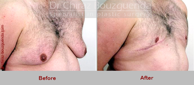 gynecomastia surgery before after results