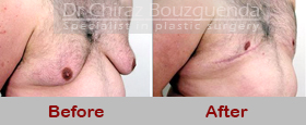 gynecomastia surgery before after pics