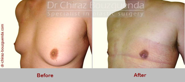 gynecomastia surgery abroad before after results