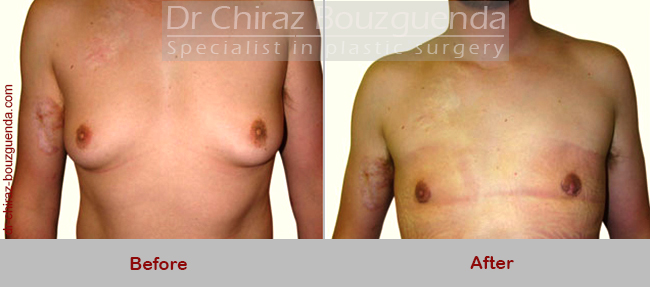 gynecomastia surgery abroad before after photos