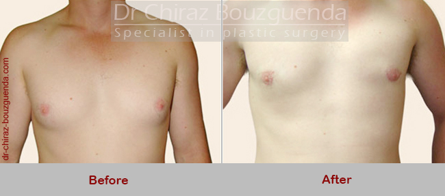 male breast reduction abroad before after