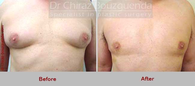 male breast reduction surgery before after