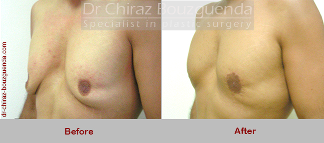 male breast reduction surgery before after results