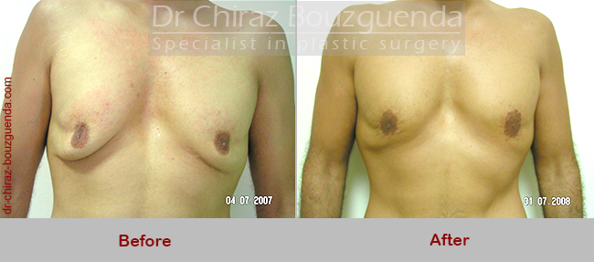 male breast reduction surgery before after pictures