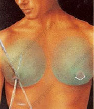 gynecomastia abroad