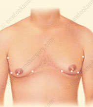 gynecomastia surgery tunisia