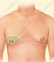 male breast reduction tunisia