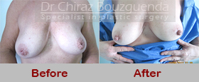 inverted nipple correction surgery before after