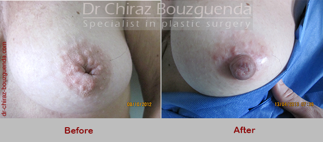 inverted nipple correction surgery before after pictures