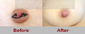 nipple correction surgery before after