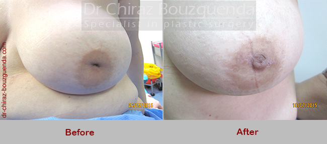 nipple correction surgery before after pics