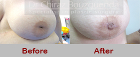 nipple correction surgery before after pictures