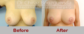 breast reduction before after