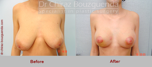 breast reduction before and after