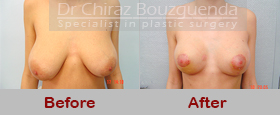 breast reduction before and after