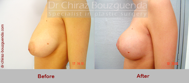 breast reduction before and after