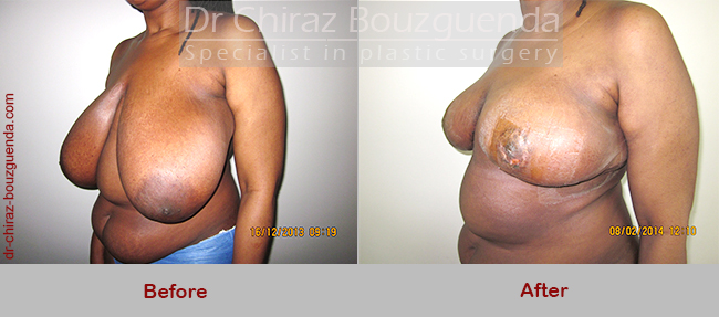 breast reduction before after photos