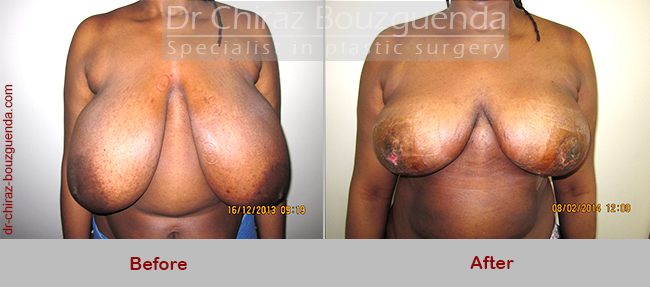 breast reduction before after photos
