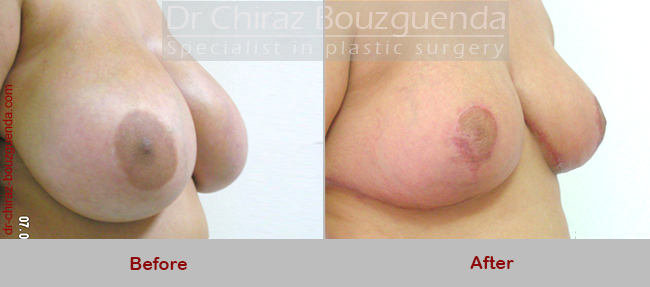 breast reduction before after pictures