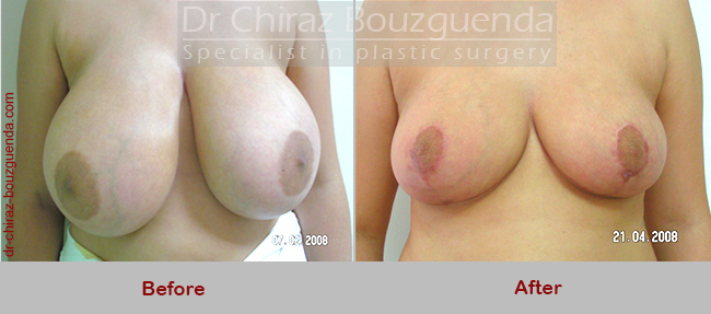 breast reduction before after pictures