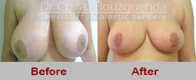 breast reduction before after photos