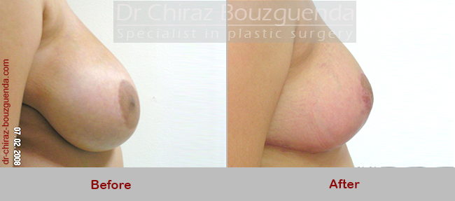 breast reduction before after pictures