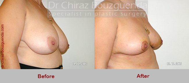 breast reduction before after