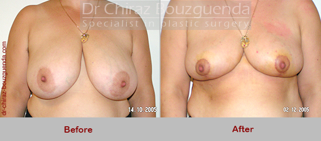 breast reduction before after