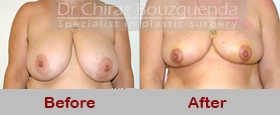 breast reduction before after