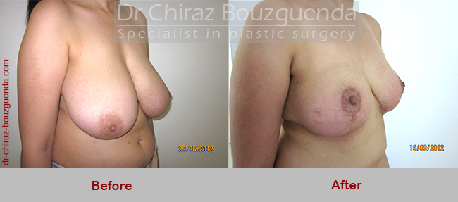 breast reduction before after