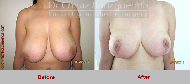 breast reduction before after