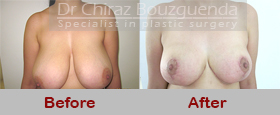 breast reduction before after