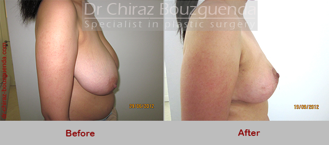 breast reduction before after