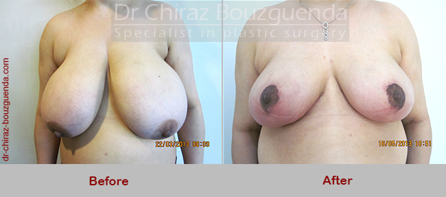 breast reduction before after