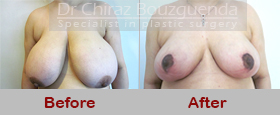 breast reduction before after