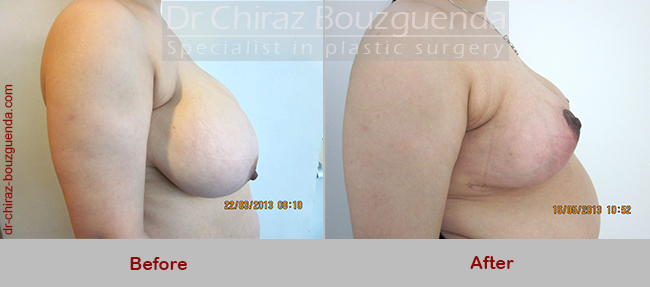 breast reduction before after