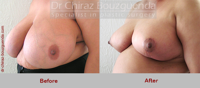 breast reduction before after